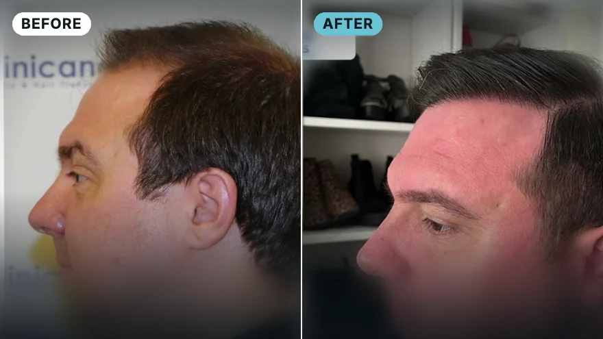 Adam · 4,600 grafts · 12-month result