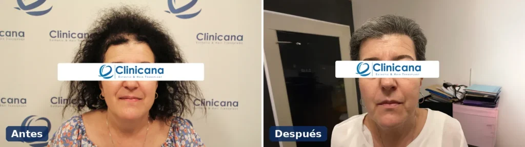 Injerto capilar en mujeres en Clinicana: vista frontal de la misma paciente antes y después