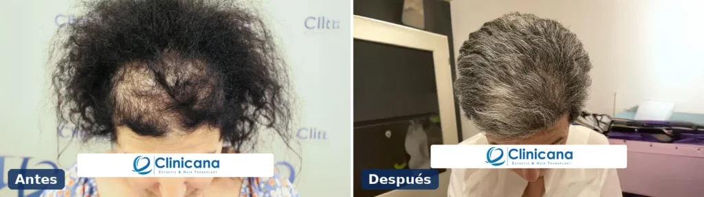 Injerto capilar en mujeres antes y después, vista superior con pérdida de densidad en la parte delantera