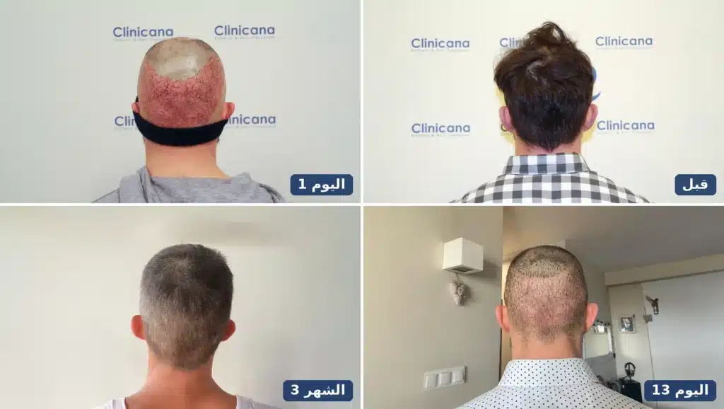 زراعة الشعر من الخلف قبل العملية وفي اليوم 1 واليوم 13 والشهر 3