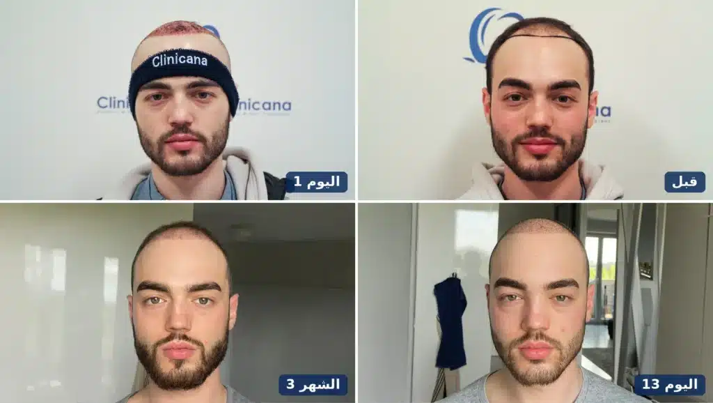 زراعة خط الشعر الأمامي قبل العملية وفي اليوم 1 واليوم 13 والشهر 3