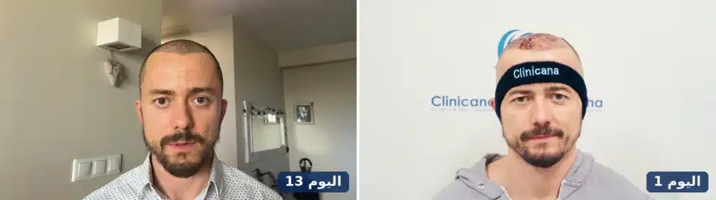 خط الشعر في اليوم الأول بعد الزراعة مقارنة باليوم 13 بعد سقوط القشور