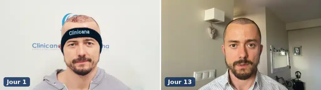 Ligne frontale au jour 1 après une greffe comparée au jour 13 après la chute des croûtes