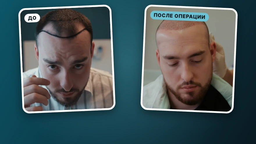Евгений · 3 300 графтов