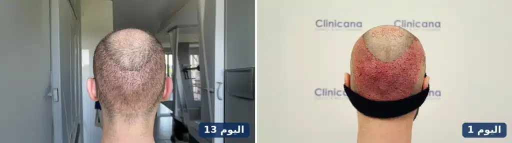 القشور على التاج في اليوم الأول بعد زراعة الشعر مقارنة بفروة رأس نظيفة في اليوم 13