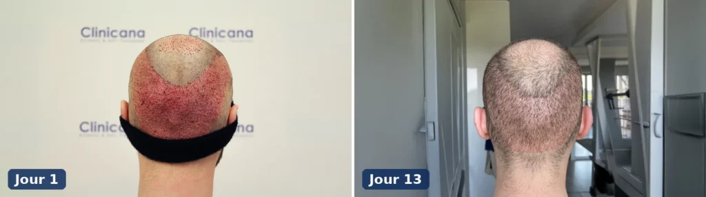 Croûtes sur le vertex au jour 1 après une greffe de cheveux comparées au cuir chevelu propre au jour 13